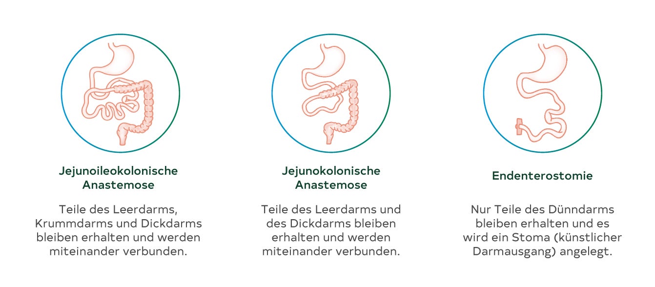 Die drei Typen des Kurzdarmsyndroms werden grafisch dargestellt.