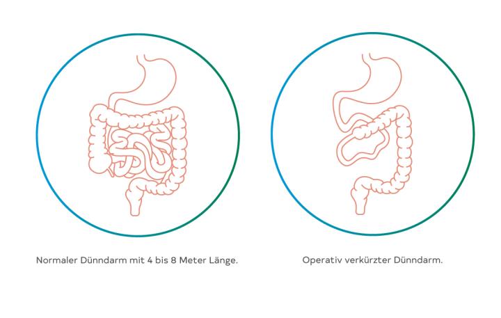 Die unterschiedlichen Laengen der Därme werden gezeigt, sodass erkennbar ist, wie ein Dünndarm aussieht und wie er sich verändert, wenn er operativ gekürzt wurde.